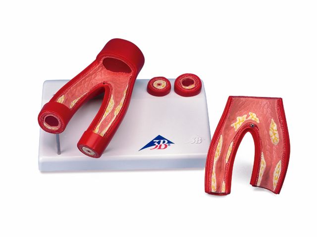 Modelo de Arteriosclerose com Seção Cruzada da Artéria - em 2 Partes - G40 - 3B Scientific Modelo de Arteriosclerose com Seção Cruzada da Artéria - em 2 Partes - G40 - 3B Scientific