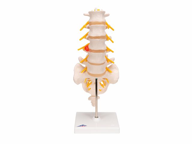Coluna Vertebral Lombar com Disco Intervertebral Prolapso - A76/5 - 3B Scientific Coluna Vertebral Lombar com Disco Intervertebral Prolapso - A76/5 - 3B Scientific