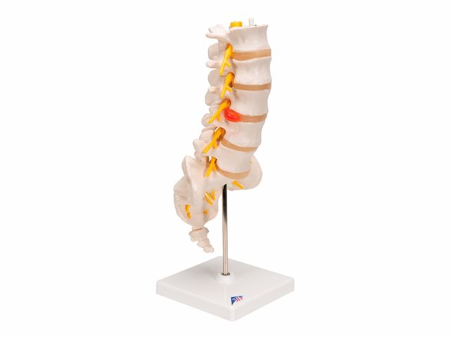 Coluna Vertebral Lombar com Disco Intervertebral Prolapso - A76/5 - 3B Scientific Coluna Vertebral Lombar com Disco Intervertebral Prolapso - A76/5 - 3B Scientific
