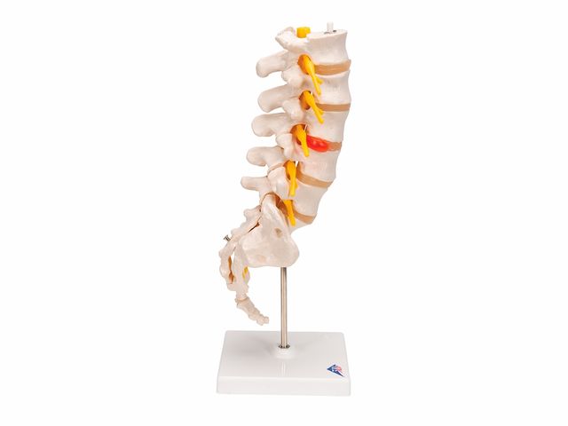 Coluna Vertebral Lombar com Disco Intervertebral Prolapso - A76/5 - 3B Scientific Coluna Vertebral Lombar com Disco Intervertebral Prolapso - A76/5 - 3B Scientific