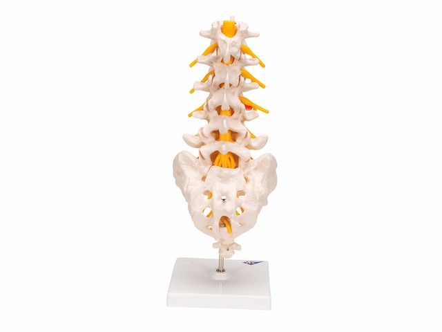 Coluna Vertebral Lombar com Disco Intervertebral Prolapso - A76/5 - 3B Scientific Coluna Vertebral Lombar com Disco Intervertebral Prolapso - A76/5 - 3B Scientific