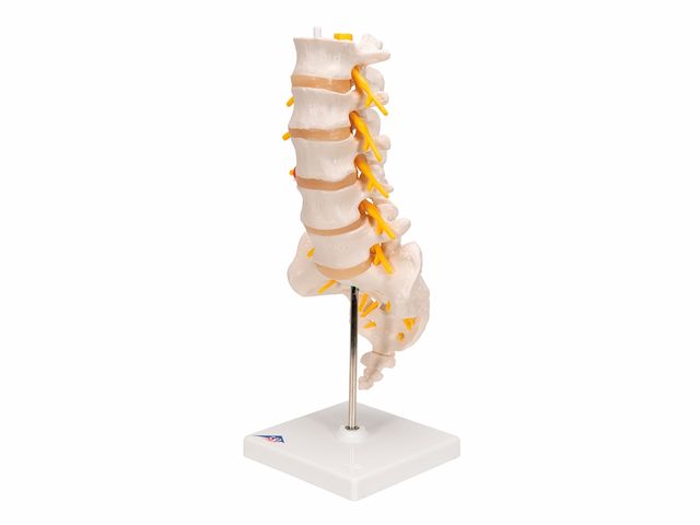 Coluna Vertebral Lombar com Disco Intervertebral Prolapso - A76/5 - 3B Scientific Coluna Vertebral Lombar com Disco Intervertebral Prolapso - A76/5 - 3B Scientific