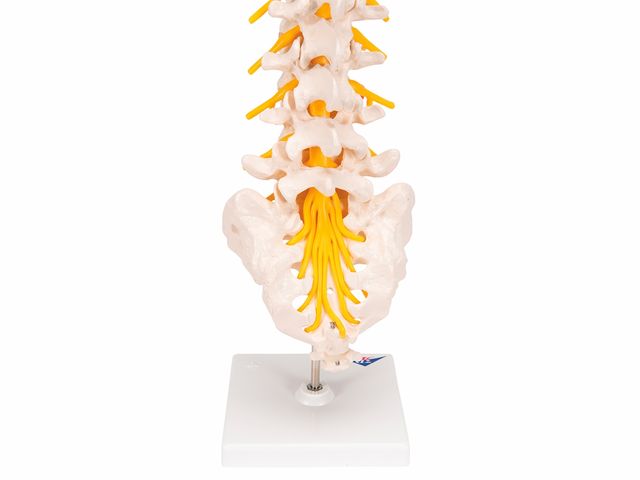 Coluna Vertebral Lombar com Disco Intervertebral Prolapso - A76/5 - 3B Scientific Coluna Vertebral Lombar com Disco Intervertebral Prolapso - A76/5 - 3B Scientific