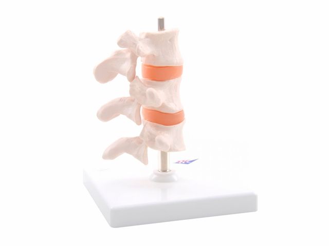 Modelo de Osteoporose de luxo - A78 - 3B Scientific Modelo de Osteoporose de luxo - A78 - 3B Scientific