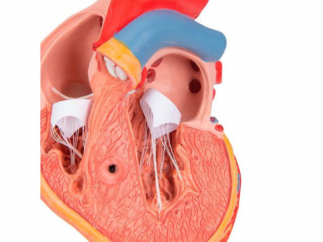 Coração Clássico com Hipertrofia Ventricular - em 2 Partes - G04 - 3B Scientific Coração Clássico com Hipertrofia Ventricular - em 2 Partes - G04 - 3B Scientific