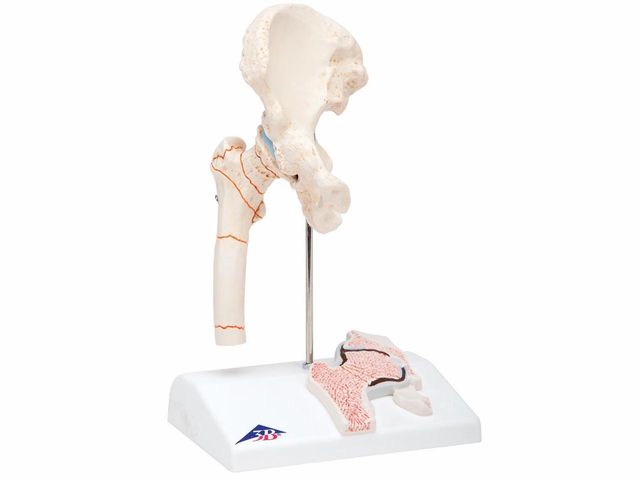 Fratura de Fêmur e Artrose da Articulação Coxofemoral - 3B Scientific Fratura de Fêmur e Artrose da Articulação Coxofemoral - 3B Scientific