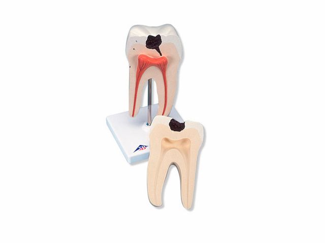 Mola Inferior com Raiz Dupla - Inserção de Cáries - em 2 Partes - D10/4 - 3B Scientific Mola Inferior com Raiz Dupla - Inserção de Cáries - em 2 Partes - D10/4 - 3B Scientific