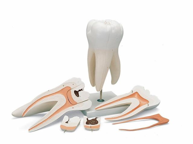 Molar com Cáries - 15x o Tamanho Natural - em 6 Partes - D15 - 3B Scientific Molar com Cáries - 15x o Tamanho Natural - em 6 Partes - D15 - 3B Scientific
