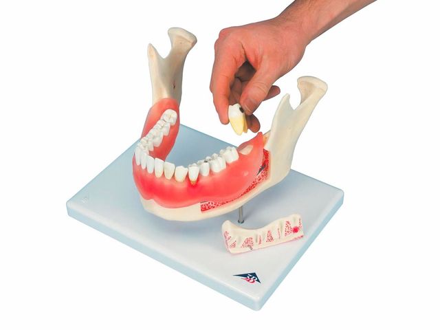 Doença Dental - 2x o Tamanho Natural - D26 - 3B Scientific Doença Dental - 2x o Tamanho Natural - D26 - 3B Scientific