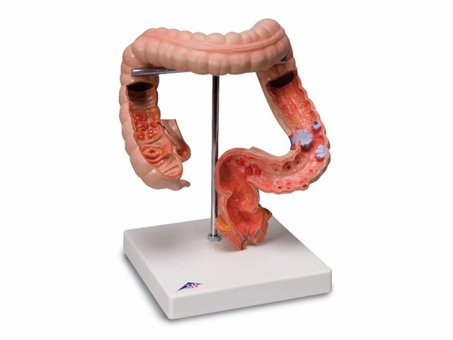 Patologias Intestinais - K55 - 3B Scientific Patologias Intestinais - K55 - 3B Scientific
