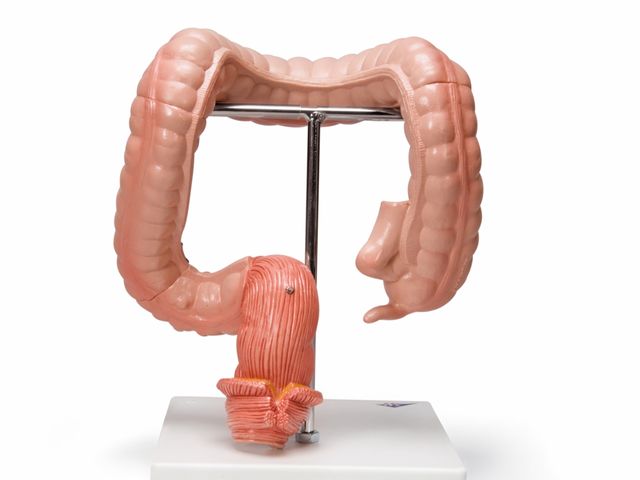 Patologias Intestinais - K55 - 3B Scientific Patologias Intestinais - K55 - 3B Scientific
