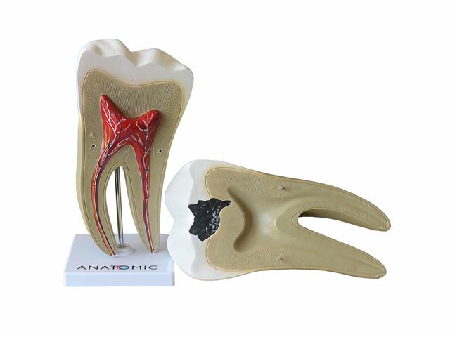 Dente Molar Ampliado - Saudável e com Cáries - TGD-0311-B - Anatomic Dente Molar Ampliado - Saudável e com Cáries - TGD-0311-B - Anatomic