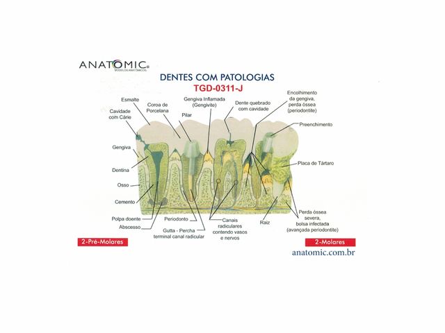 Patologias Dentárias - em Placa Explicativa - TGD-0311-J - Anatomic Patologias Dentárias - em Placa Explicativa - TGD-0311-J - Anatomic