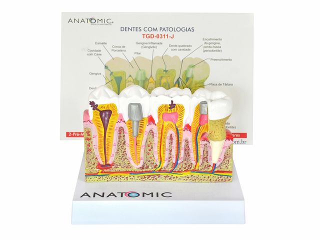 Patologias Dentárias - em Placa Explicativa - TGD-0311-J - Anatomic Patologias Dentárias - em Placa Explicativa - TGD-0311-J - Anatomic