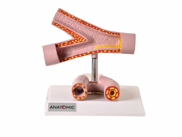 Modelo de Comparação da Artéria Saudável e Patológica - TGD-0323-D - Anatomic Modelo de Comparação da Artéria Saudável e Patológica - TGD-0323-D - Anatomic