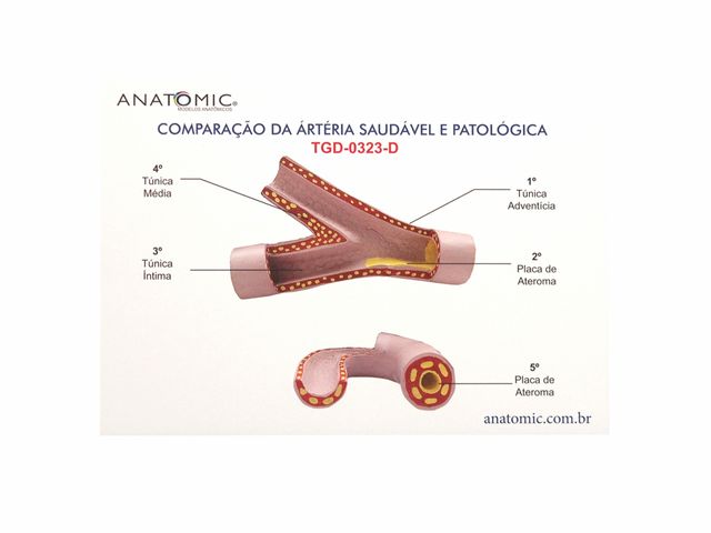 Modelo de Comparação da Artéria Saudável e Patológica - TGD-0323-D - Anatomic Modelo de Comparação da Artéria Saudável e Patológica - TGD-0323-D - Anatomic