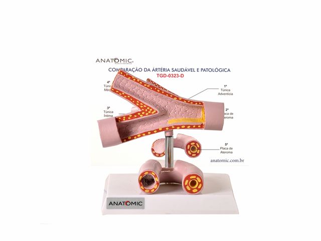 Modelo de Comparação da Artéria Saudável e Patológica - TGD-0323-D - Anatomic Modelo de Comparação da Artéria Saudável e Patológica - TGD-0323-D - Anatomic