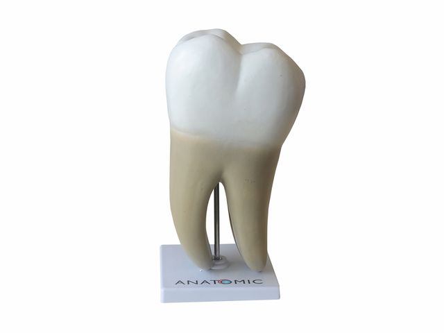 Dente Molar com Evolução da Cárie - em 8 Partes - TGD-0311-G - Anatomic