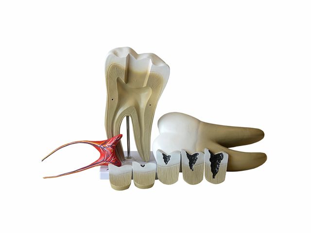 Dente Molar com Evolução da Cárie - em 8 Partes - TGD-0311-G - Anatomic Dente Molar com Evolução da Cárie - em 8 Partes - TGD-0311-G - Anatomic