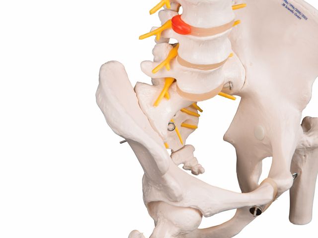 Coluna Flexível Luxo com Cabeças de Fêmur e Disco Intervertebral Prolapso - A58/6 - 3B Scientific Coluna Flexível Luxo com Cabeças de Fêmur e Disco Intervertebral Prolapso - A58/6 - 3B Scientific